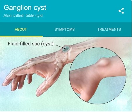 artistic rendering of a ganglion cyst