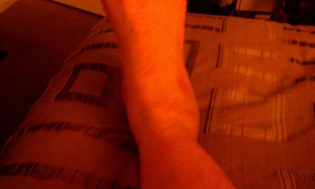 Author's sprained right ankle